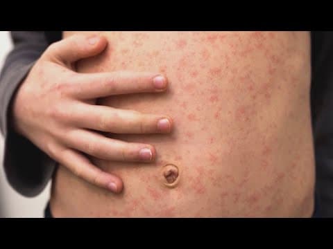 259 confirmed cases of measles reported in Texas