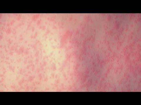 Measles cases reach highest levels since 1992, San Diego health experts on alert