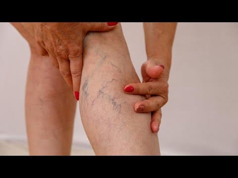 What to do about varicose veins | Check Up 13