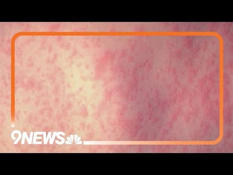3rd measles case confirmed in Denver area
