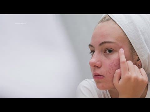 Vaccine from UCSD researchers targets acne inflammation