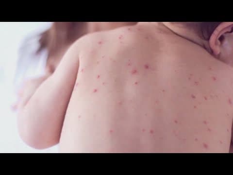 Six confirmed measles cases in Tennessee