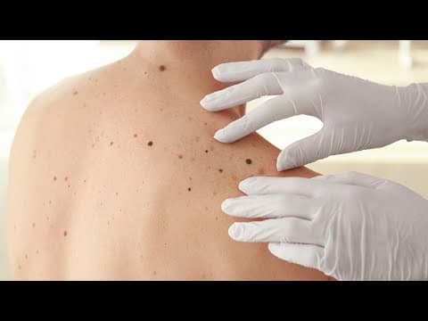 Skin cancer prevention and detection | Real Men Wear Gowns