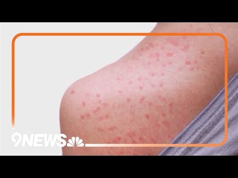 Health officials use lessons learned from COVID for measles
