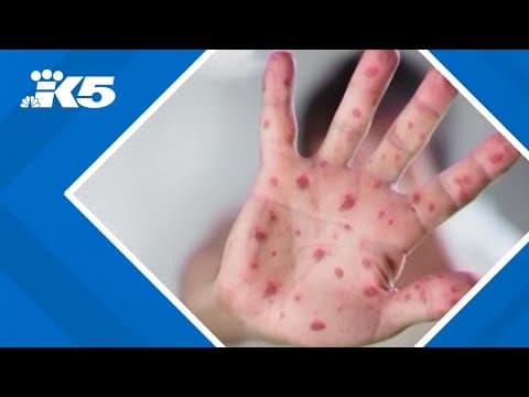 Measles case confirmed in King County