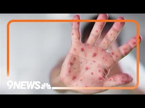 Measles cases up to 327 in west Texas