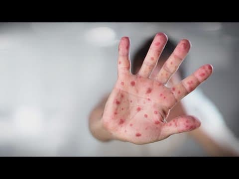 Officials warn of measles at Children's Museum of Indianapolis solar eclipse watch party