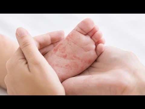 5 more measles cases confirmed in Indiana this year