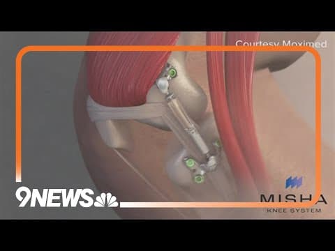 Steamboat Springs runner the first in Colorado to receive FDA medical device for his knee