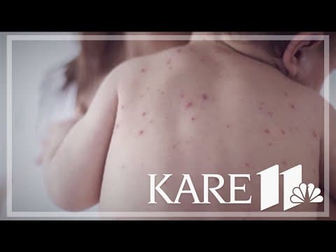 Health experts watching measles closely as new school year begins