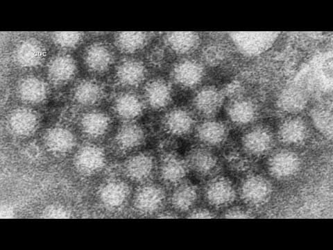 CDC says stomach viruses spreading across country
