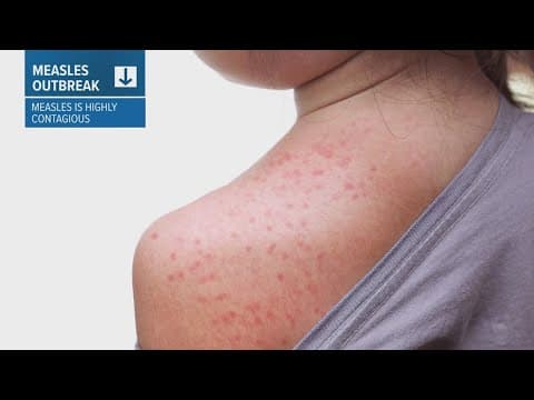 Visitors to Texas State, UTSA and San Antonio may have been exposed to Measles