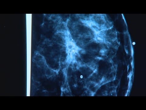 Study reveals black women 'have higher chances to die from cancer'