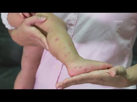 West Texas measles outbreak grows to 400 cases