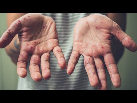 Health alert issued for Delaware County after reported outbreaks of hand, foot and mouth disease