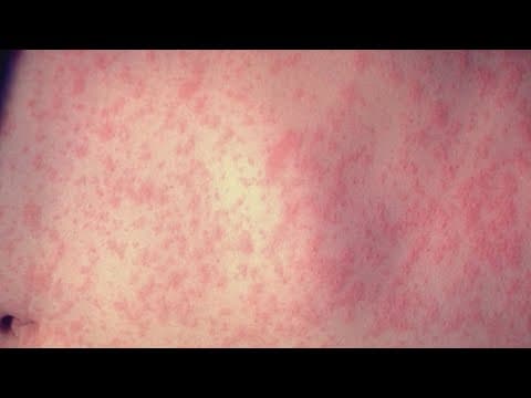 Health officials issue warning after measles outbreak in West Texas