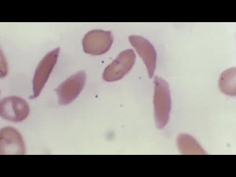 US poised to approve breakthrough treatment for sickle cell disease