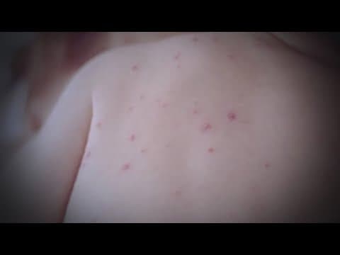 Measles outbreak continues to spread nationwide