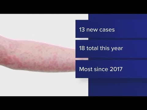 MDH: Alarming increase in measles cases