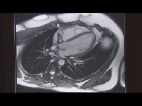 New research shows what may be causing more heart attacks among young people