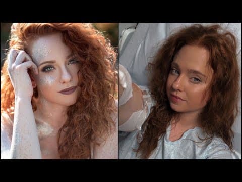 MN model shares struggle with bowel disease on social media, hoping to help others feel less alone