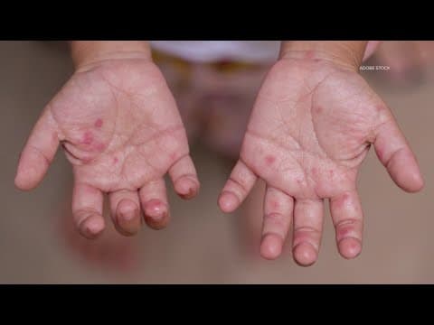 Second case of measles reported in Collin County, officials confirm