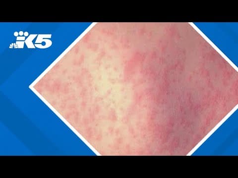 W.H.O. puts out measles warning