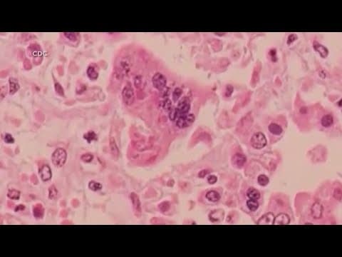 Measles cases in Texas outbreak near 200 with latest update