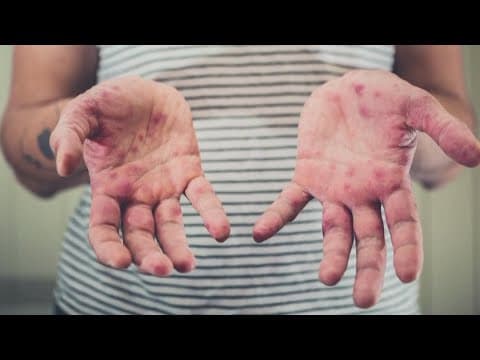 Nearly half of Indiana's youngest students behind on immunizations