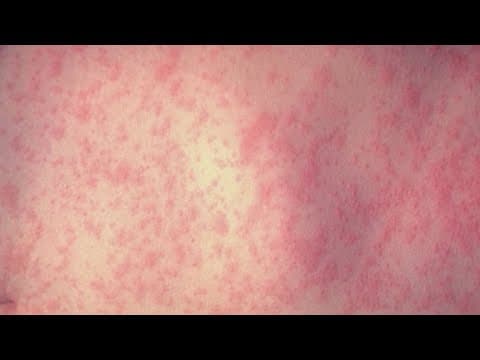 The latest measles case numbers across Texas