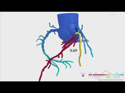 Heartflow's registry helps NFL veterans tackle heart health