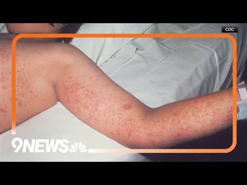 Health officials warn of potential measles exposure at Pueblo hotel