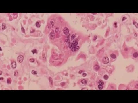 Measles outbreak in Texas reaches 48 cases, experts warn actual number may be higher