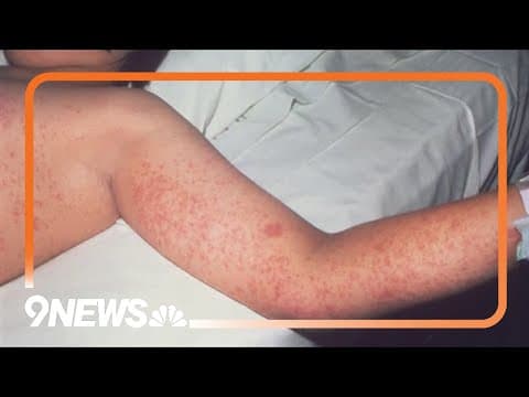 CDC suggests Vitamin A could help treat measles