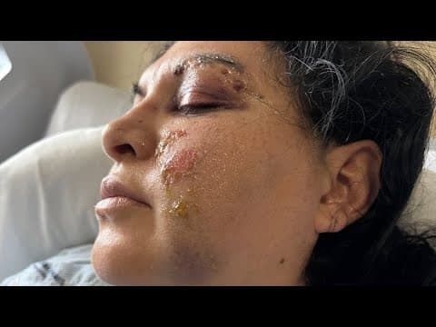 Detention officer suffers severe injuries trying to stop teens from escaping North Texas juvenile fa