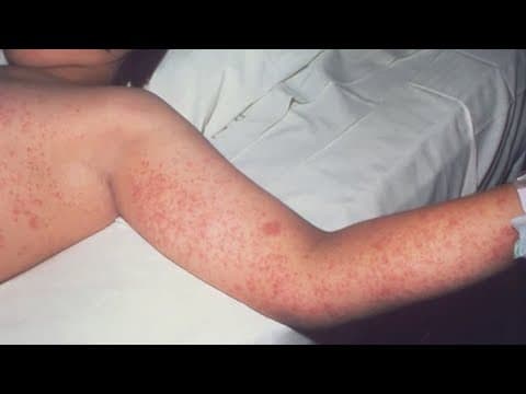 Measles outbreak continues in Texas, here's a look back at the 1990 outbreak