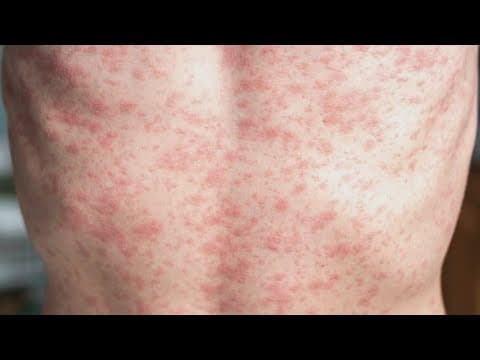 Texas measles outbreak: Latest updates Friday