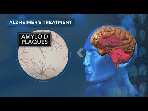 New Alzheimer's drug could help Louisianans suffering from disease.