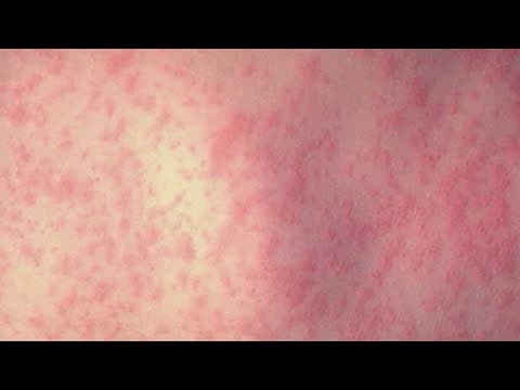 153 unvaccinated children in quarantine after measles exposure