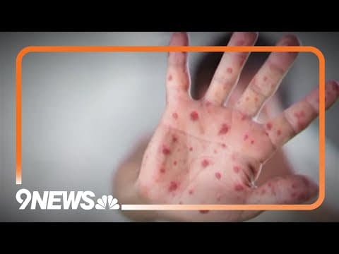 Second child confirmed dead from measles in Texas