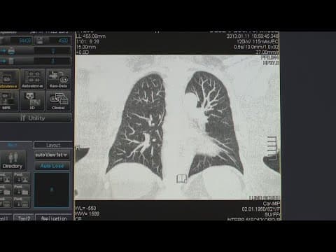 Kate Middleton cancer diagnosis a teachable moment, Louisiana doctors say