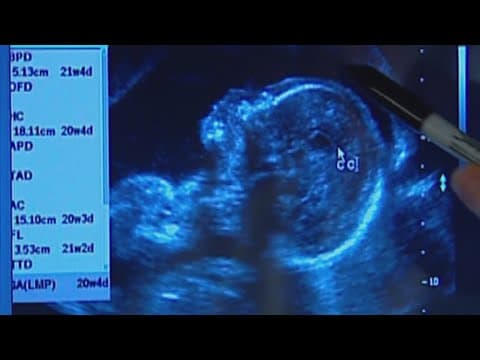 CDC reports women are having babies less often