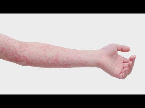 Measles outbreak continues in West Texas
