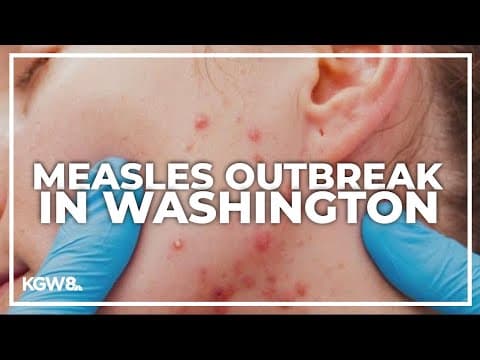 Rise in national measles cases may be a concern for Washington counties