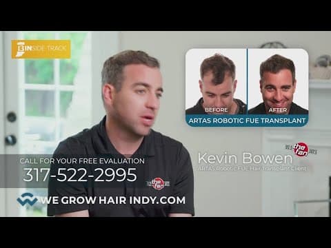 Overseas hair transplants: Why local expertise matters