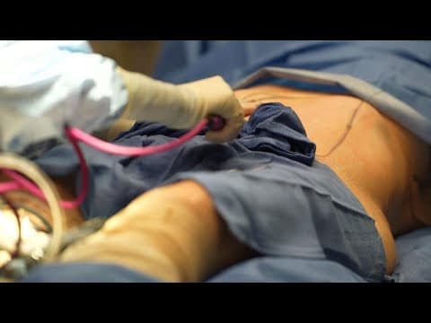 Wrinkle-free Friday: New procedure helps combat the 'Ozempic body' sag