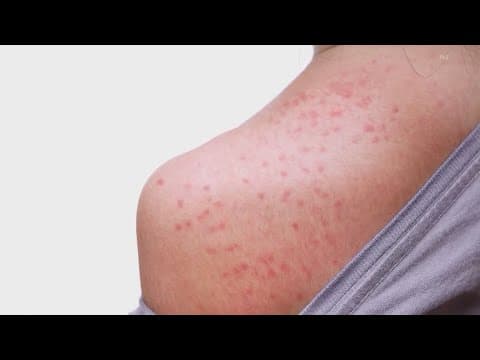 Another case of measles reported in Austin, two more potential cases in Houston, officials say