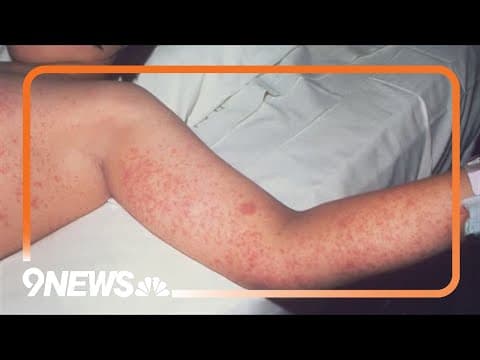 Measles cases continue to rise