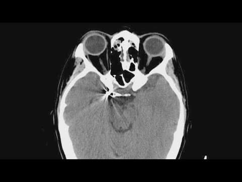 Brain aneurysms are more common than you know. Here's the risk factors to look out for