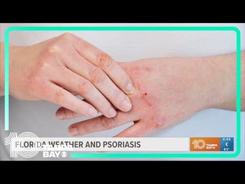 How Florida's sun could actually benefit people with psoriasis